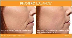 Belotero Before After Photos