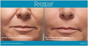 Radiesse Before and After Images