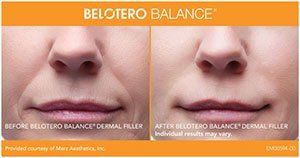 Belotero Facial Rejuvenation