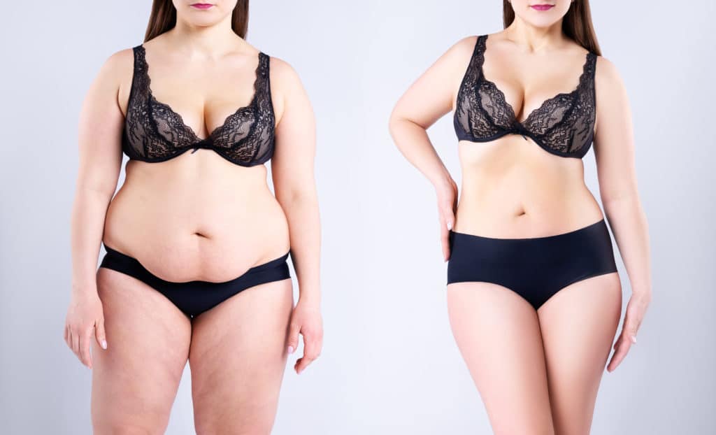 Tummy Tuck in Nassau County Long Island