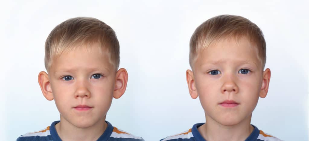 Otoplasty in Nassau County Long Island