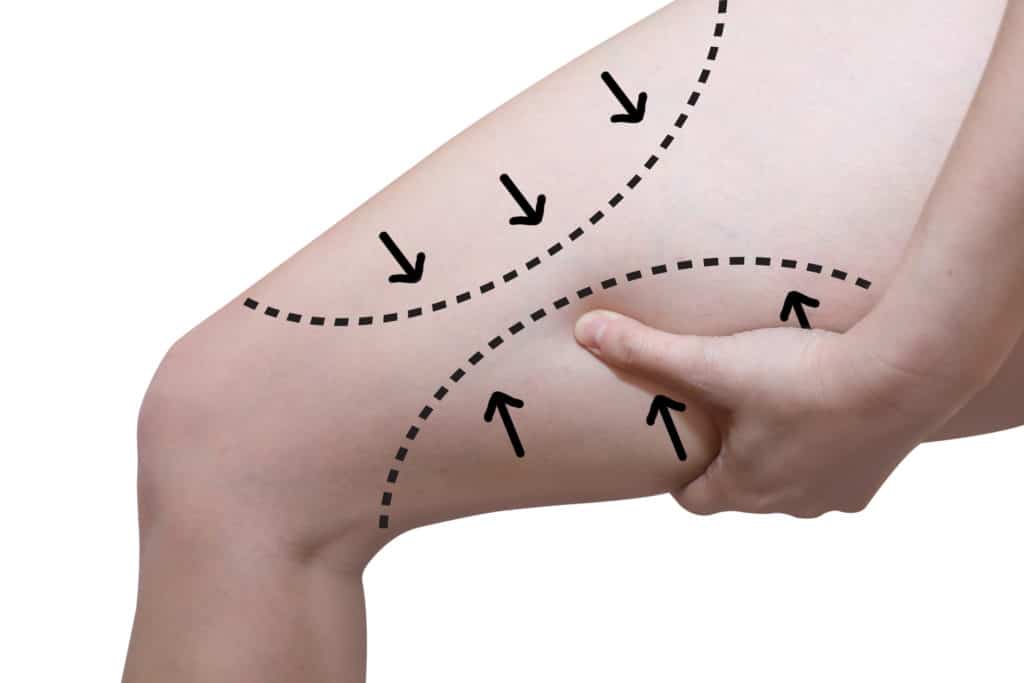 Thigh Lift in Nassau County Long Island