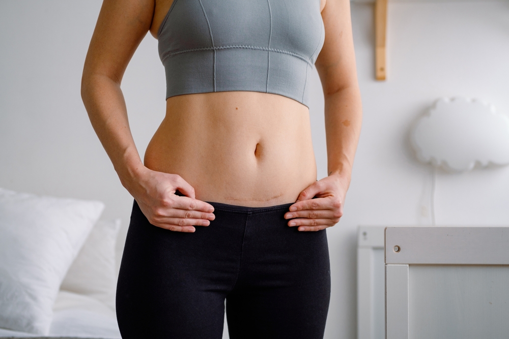 Woman has a C-section scar on her lower belly after giving birth to her first child.