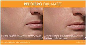 Facial Filler Patient Photos