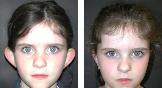 Before and After Image: Otoplasty - front