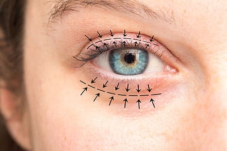 Blepharoplasty in Roslyn Heights