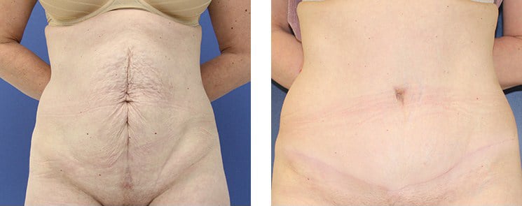 Before and After Image: Abdominoplasty - front