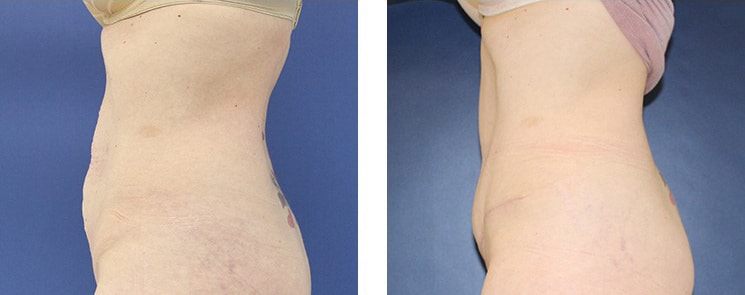 Before and After Image: Abdominoplasty - left-side