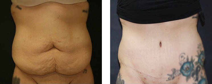 Before and After Image: Abdominoplasty - front