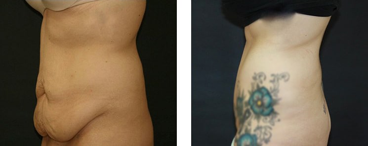 Before and After Image: Abdominoplasty - left-side