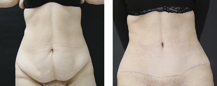 Before and After Image: Abdominoplasty - front