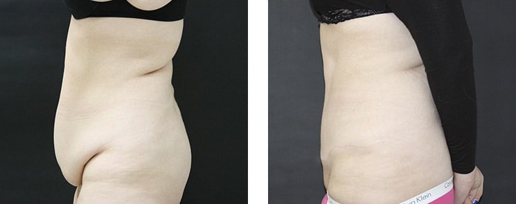 Before and After Image: Abdominoplasty - left-side
