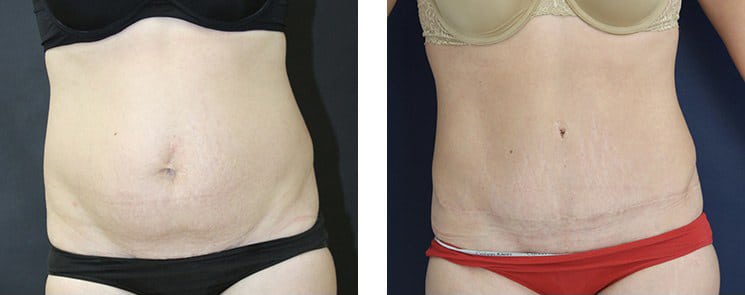 Before and After Image: Abdominoplasty - front
