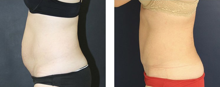 Before and After Image: Abdominoplasty - left-side