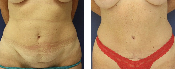 Before and After Image: Abdominoplasty - front