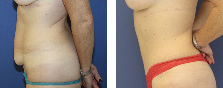 Before and After Image: Abdominoplasty - left-side