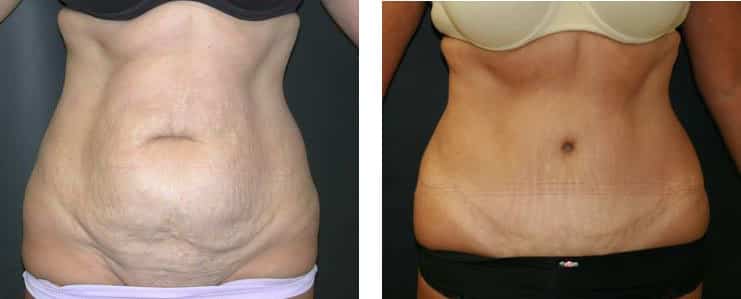 Before and After Image: Abdominoplasty - front
