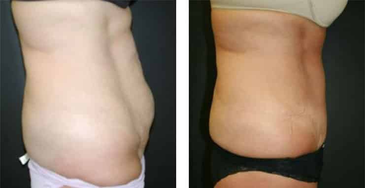 Before and After Image: Abdominoplasty - right-side