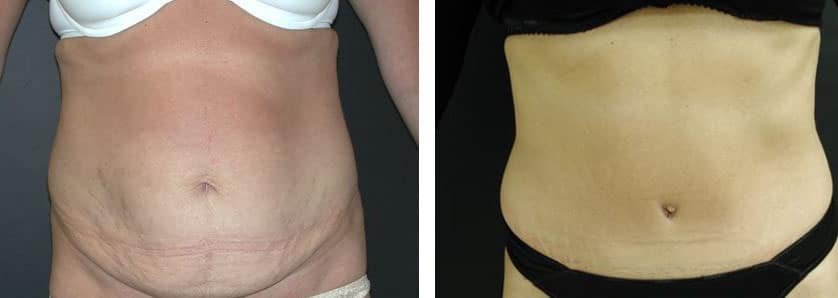 Before and After Image: Abdominoplasty - front