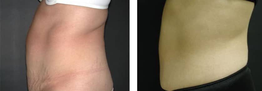 Before and After Image: Abdominoplasty - left-side