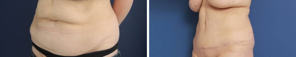 Before and After Image: Abdominoplasty - left-front-oblique