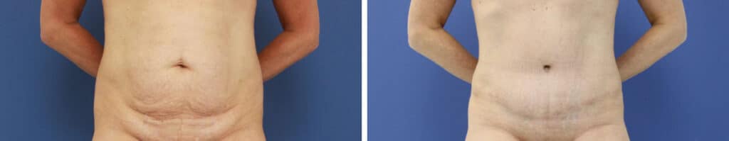 Before and After Image: Abdominoplasty - front