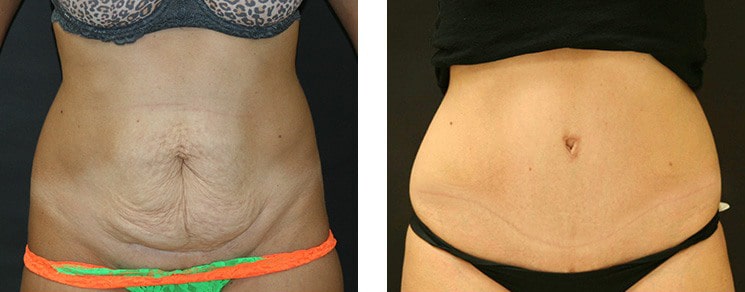 Before and After Image: Abdominoplasty - front