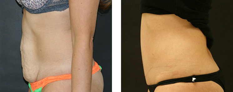 Before and After Image: Abdominoplasty - left-side