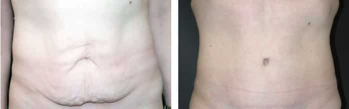 Before and After Image: Abdominoplasty - front