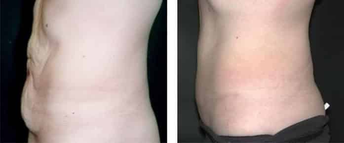 Before and After Image: Abdominoplasty - left-side
