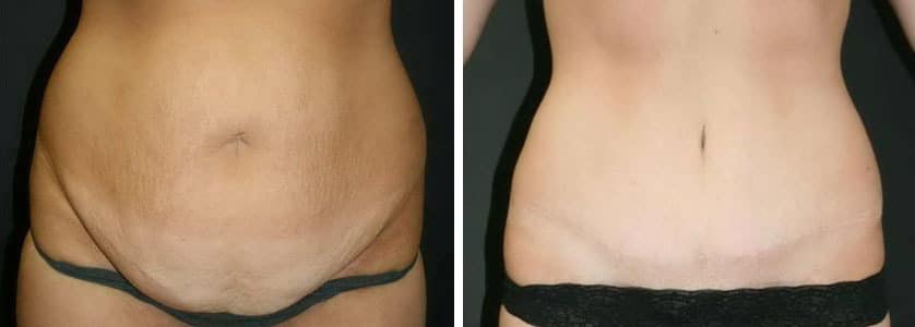 Before and After Image: Abdominoplasty - front