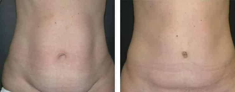 Before and After Image: Abdominoplasty - front
