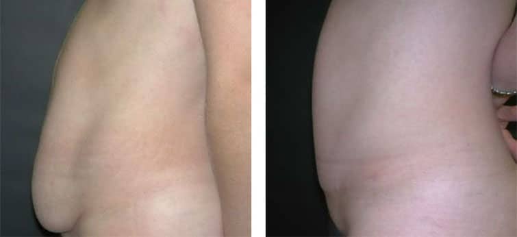 Before and After Image: Abdominoplasty - left-side