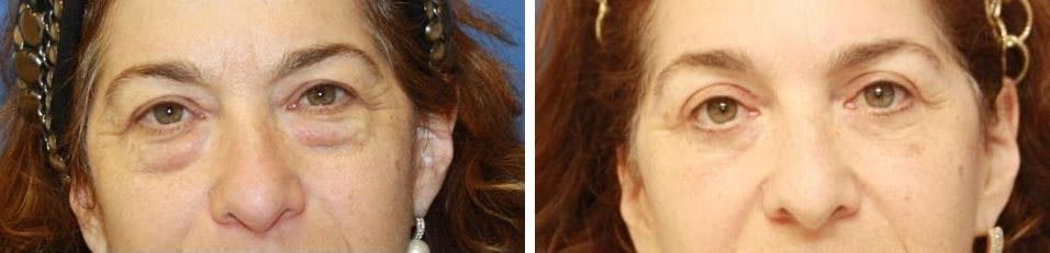 Before and After Image: Blepharoplasty - front