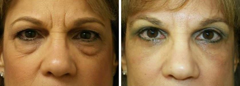 Before and After Image: Blepharoplasty - front