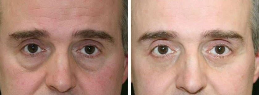 Before and After Image: Blepharoplasty - front