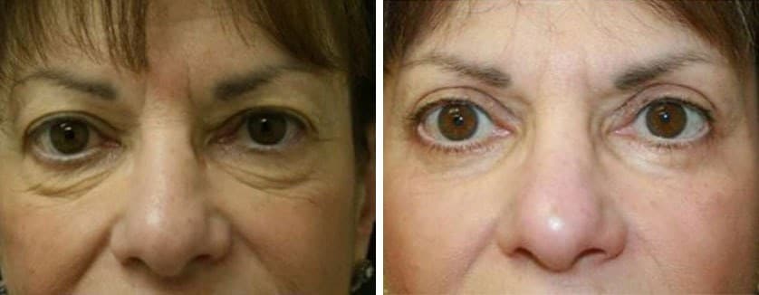 Before and After Image: Blepharoplasty - front