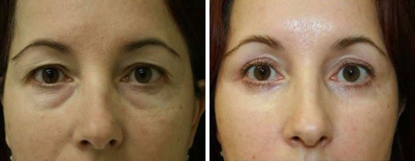 Before and After Image: Blepharoplasty - front