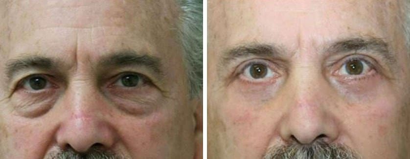 Before and After Image: Blepharoplasty - front