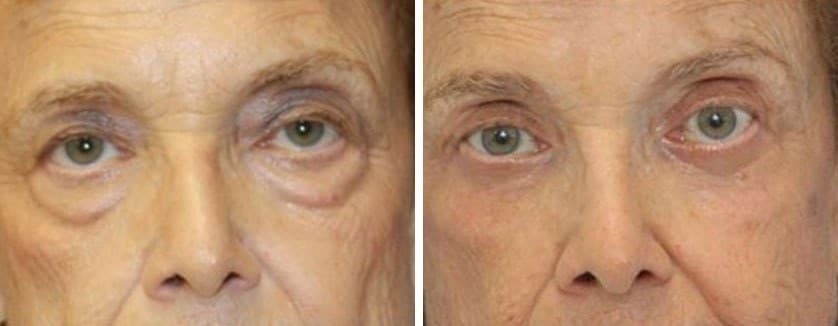 Before and After Image: Blepharoplasty - front