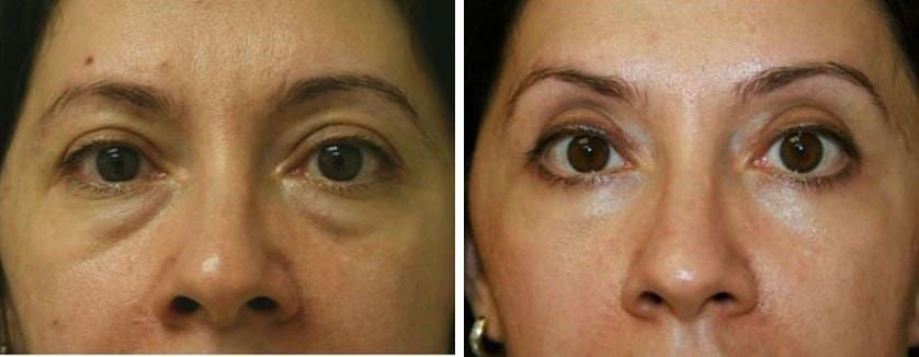 Before and After Image: Blepharoplasty - front