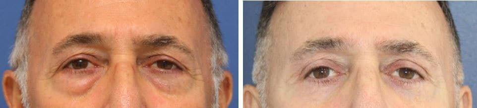Before and After Image: Blepharoplasty - front