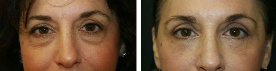 Before and After Image: Blepharoplasty - front