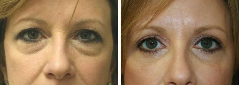 Before and After Image: Blepharoplasty - front