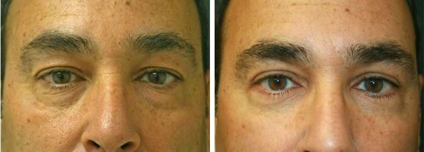 Before and After Image: Blepharoplasty - front