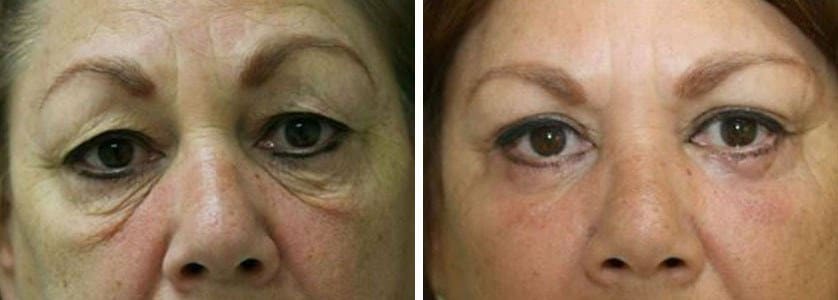 Before and After Image: Blepharoplasty - front