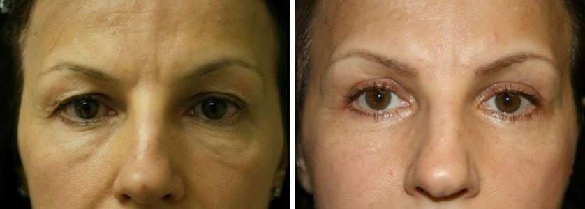 Before and After Image: Blepharoplasty - front