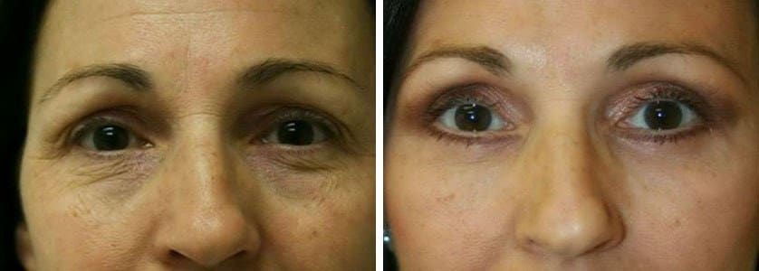 Before and After Image: Blepharoplasty - front