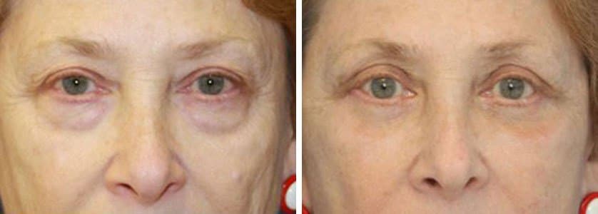 Before and After Image: Blepharoplasty - front