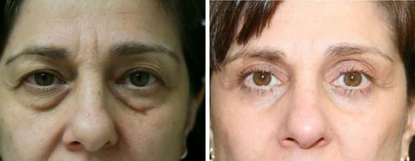 Before and After Image: Blepharoplasty - front